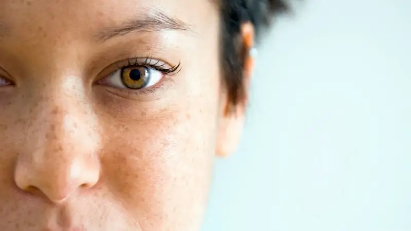 رئالیتی درمان لک | کدام لک‌ها درمان قطعی دارند؟