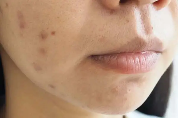 لک‌های ناشی از جای جوش
