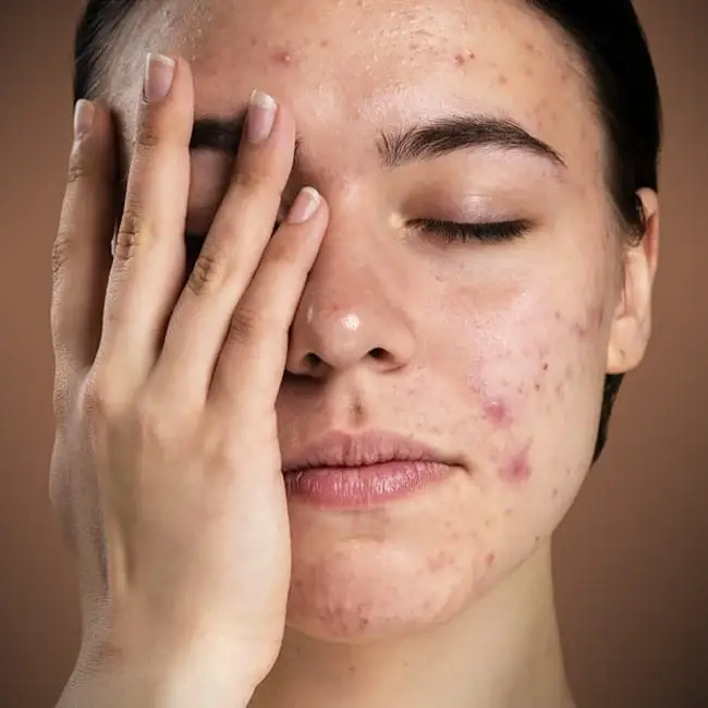 چرا نباید جوش‌های صورت را دستکاری کنیم؟