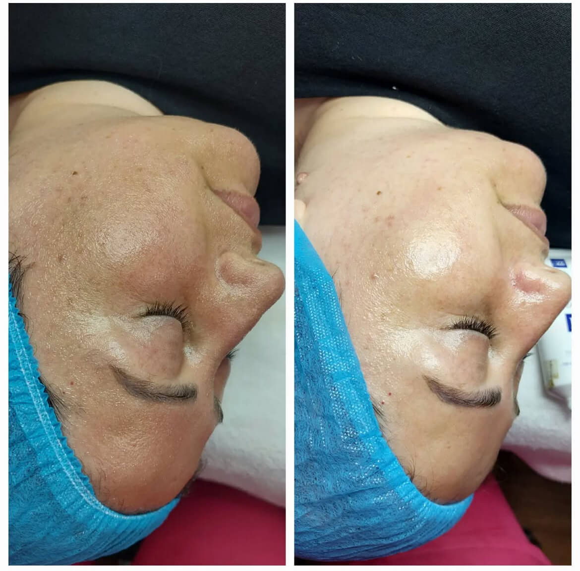 کربوکسی تراپی
