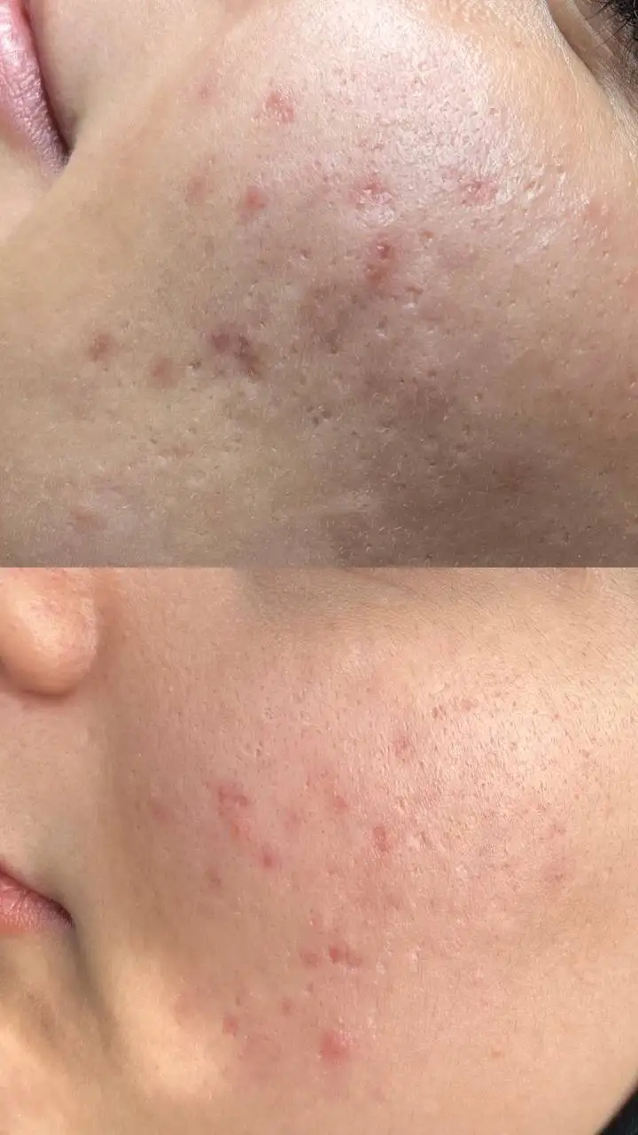 قبل و بعد تک جلسه ای گرین پیل