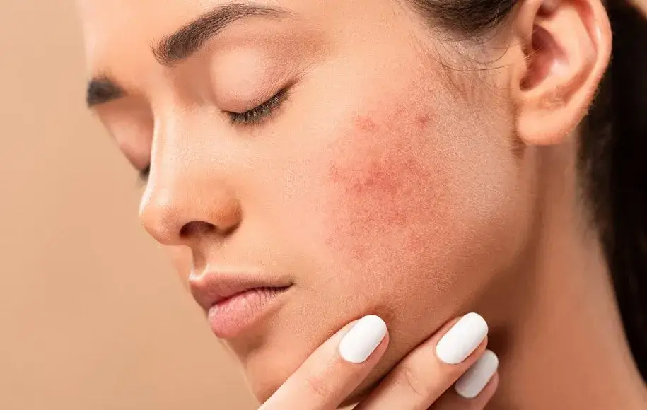 لک‌های ناشی از جای جوش