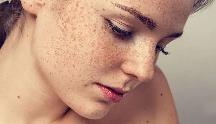 ملاسما چیست و چگونه باید با آن برخورد کرد ؟