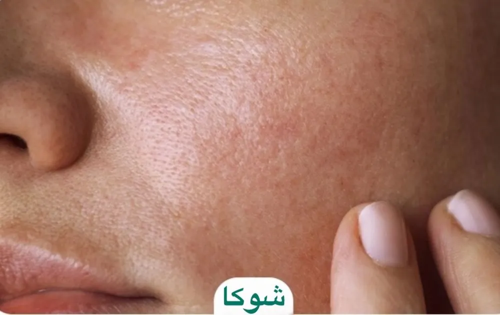 دهیدراته شدن پوست؛ علل، نشانه‌ها و بهترین روش‌های درمان خانگی و کلینیکی