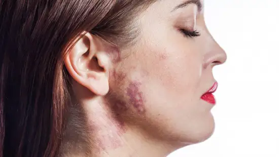 لک‌های مادرزادی یا خال‌های پیگمانته