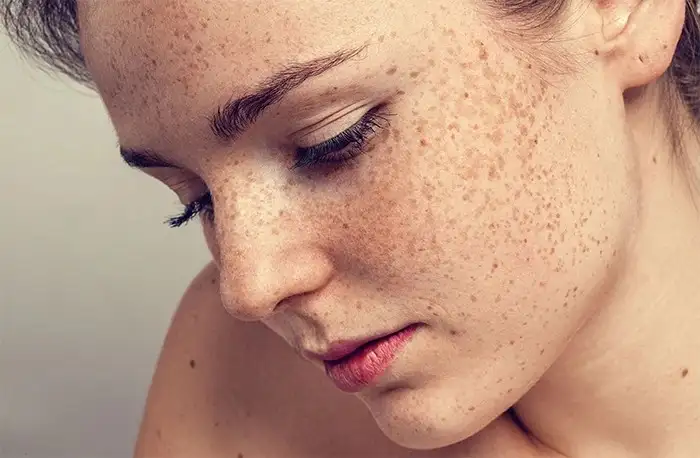 اثر استرس و کورتیزول بر سلامت پوست | رابطه ذهن و پوست